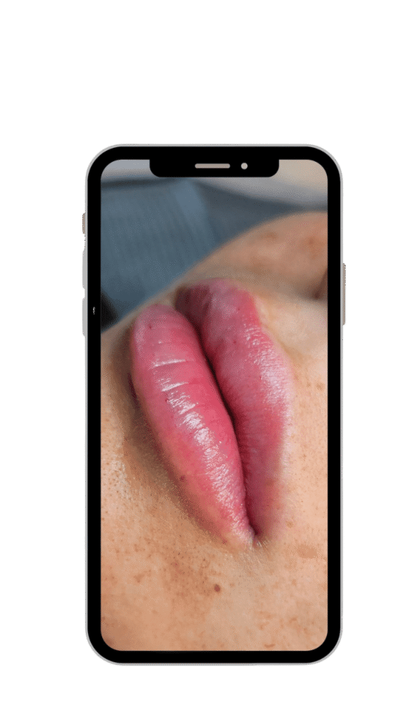 Hyaluronpen Behandlung Wr. Neustadt, Baden, Mödling, Neunkirchen