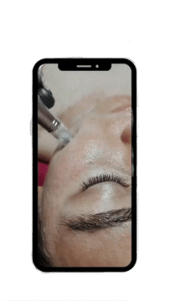 Microneedling Wr. Neustadt, Baden, Mödling & Neunkirchen